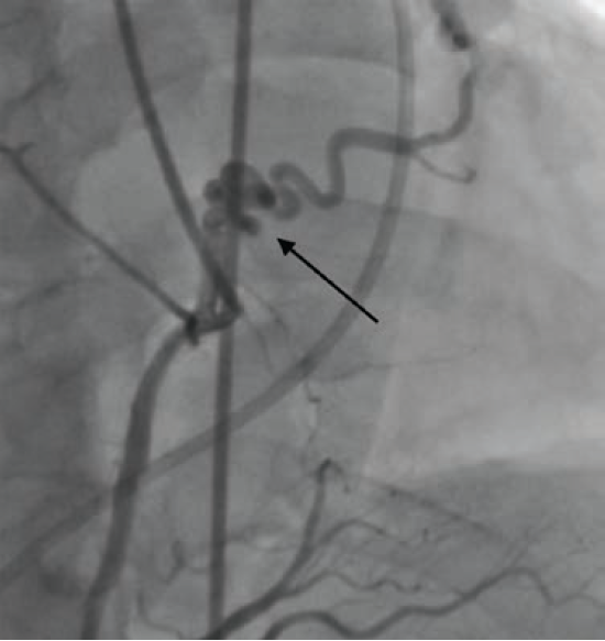 Figure 2, Case 2. Right coronary artery (RCA) to PA fistula (junction, arrow), obtained under fluoroscopy during left heart catheterization.