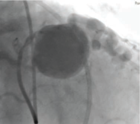 Figure 3, Case 2. Giant, spherical coronary artery aneurysm, obtained under fluoroscopy during left heart catheterization.