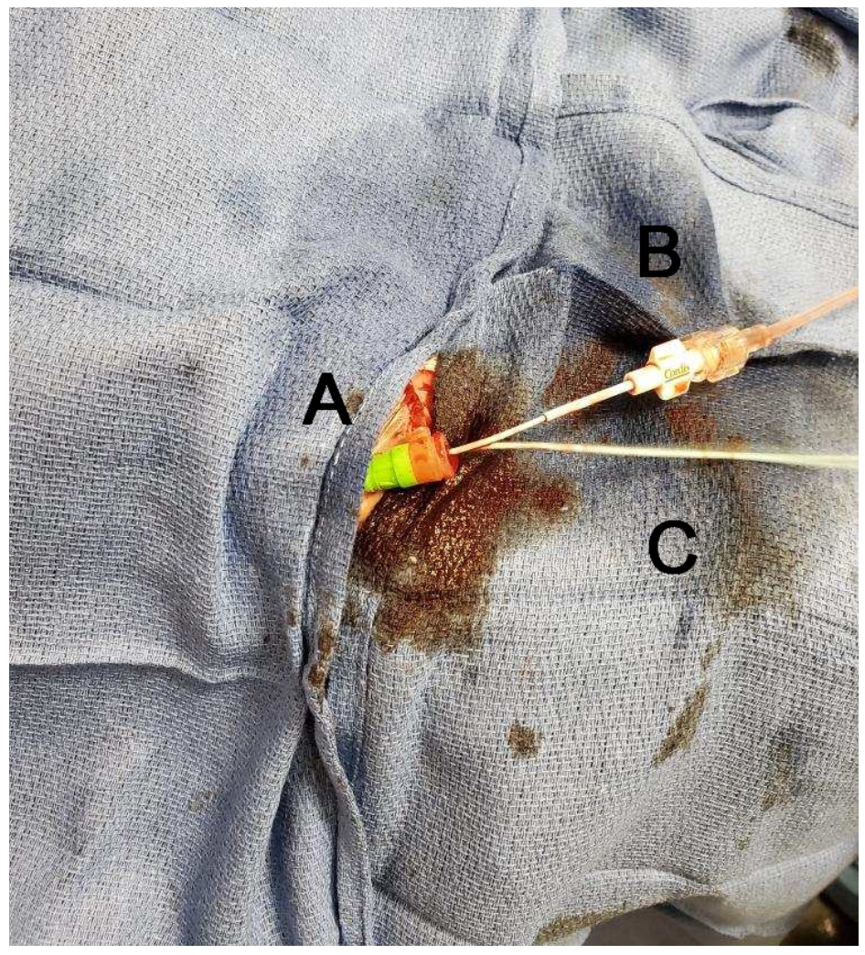 Caballero Aortic Stenosis Figure 1