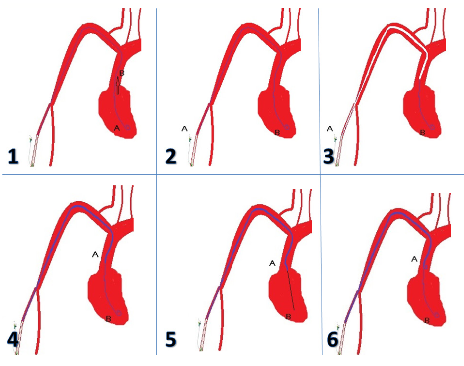 Caballero Aortic Stenosis Figure 3