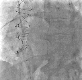 Figure B. Snare technique