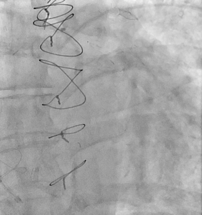 Figure C. Migration of coronary sinus reducer