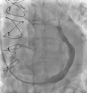 Figure D. Implantation of the second device