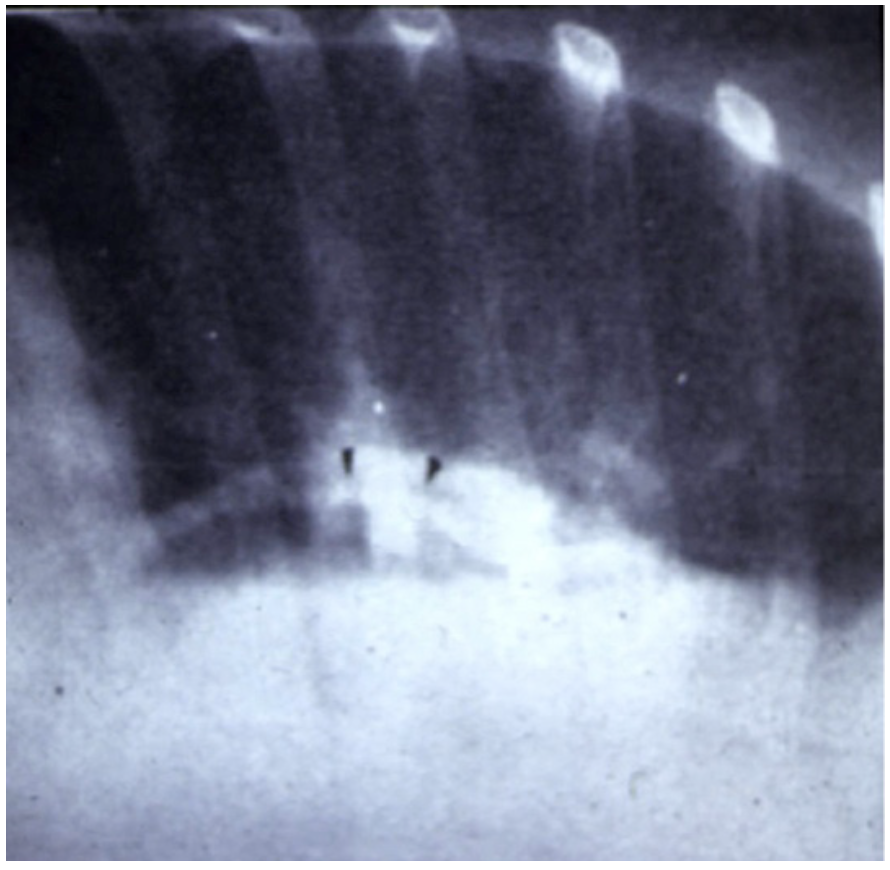 Caridi Digital Subtraction Angiography Figure 1