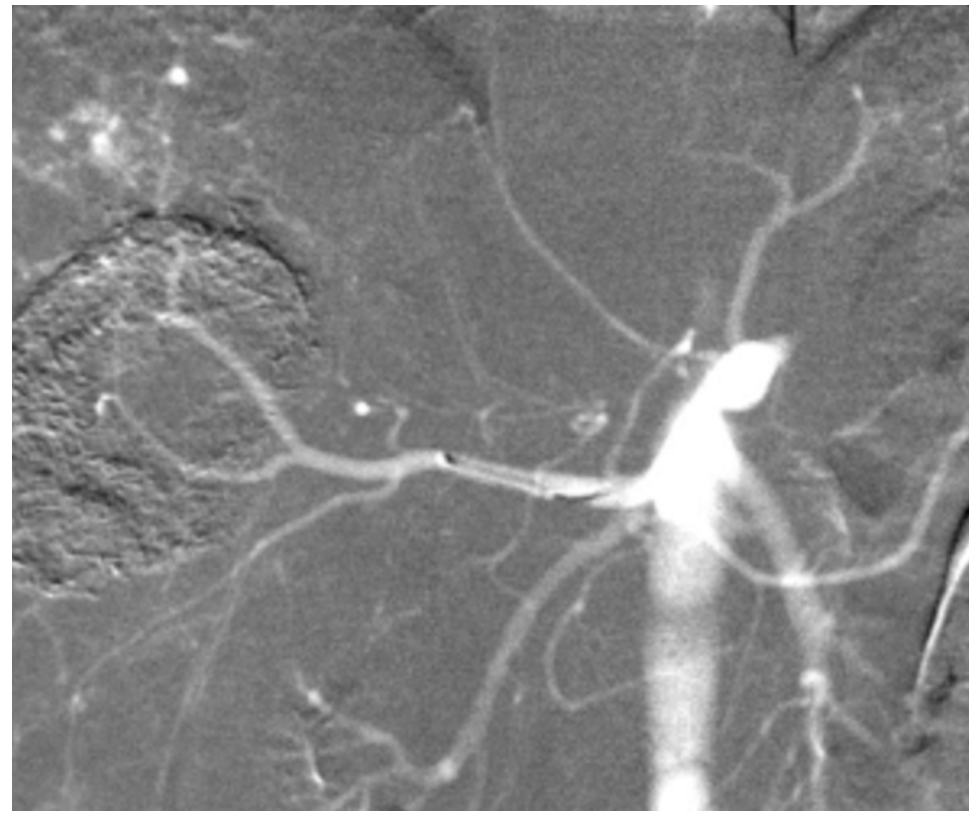 Caridi Digital Subtraction Angiography Figure 12