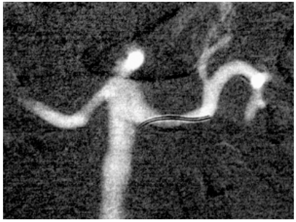 Caridi Digital Subtraction Angiography Figure 13