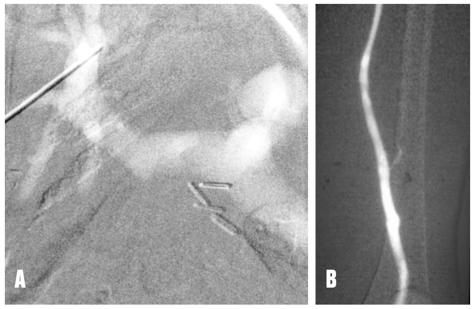Caridi Digital Subtraction Angiography Figure 14