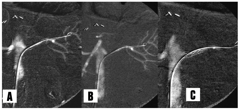 Caridi Digital Subtraction Angiography Figure 15