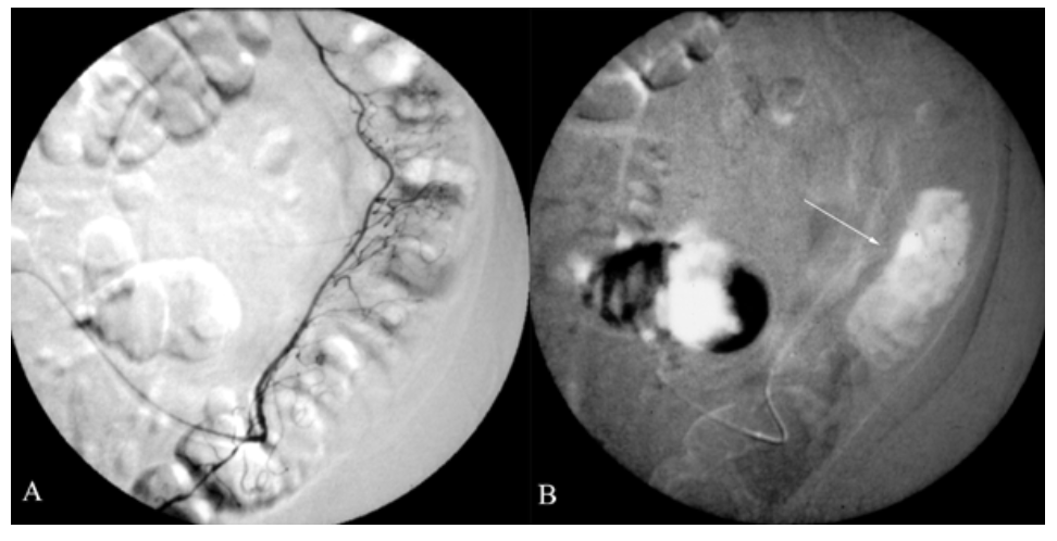 Caridi Digital Subtraction Angiography Figure 16