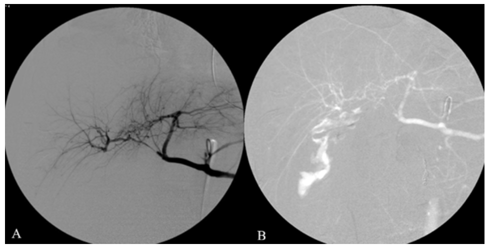 Caridi Digital Subtraction Angiography Figure 17