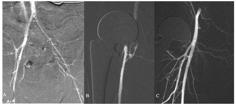 Caridi Digital Subtraction Angiography Figure 18