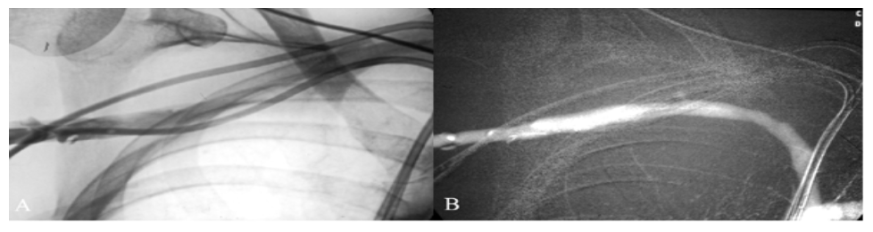 Caridi Digital Subtraction Angiography Figure 19
