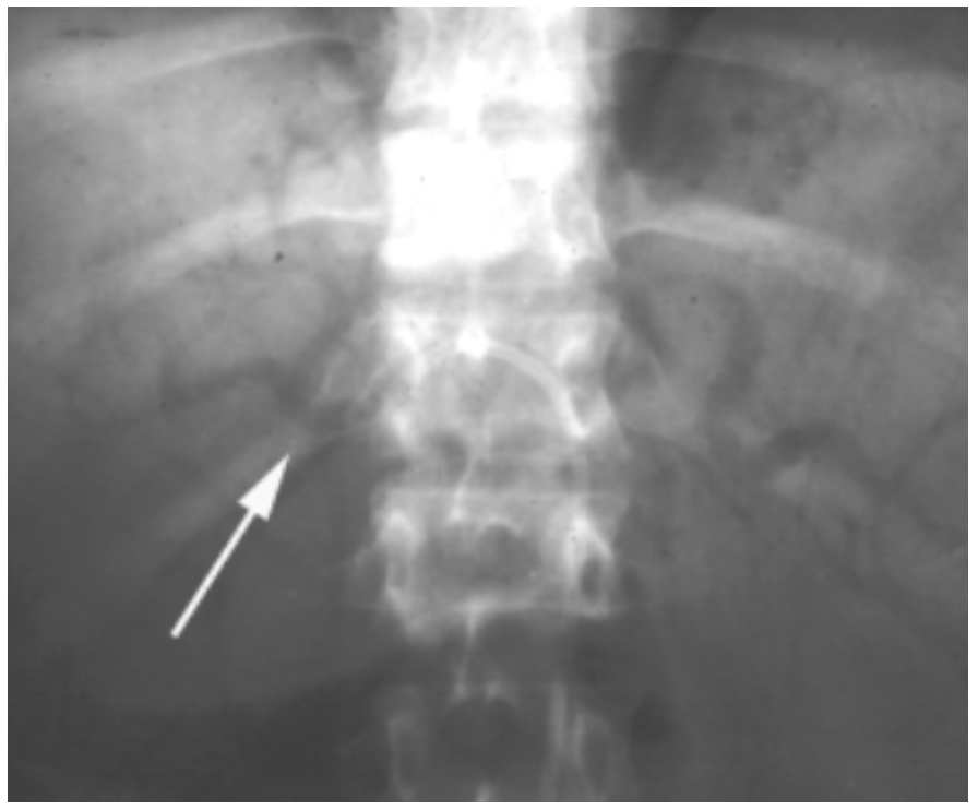 Caridi Digital Subtraction Angiography Figure 2