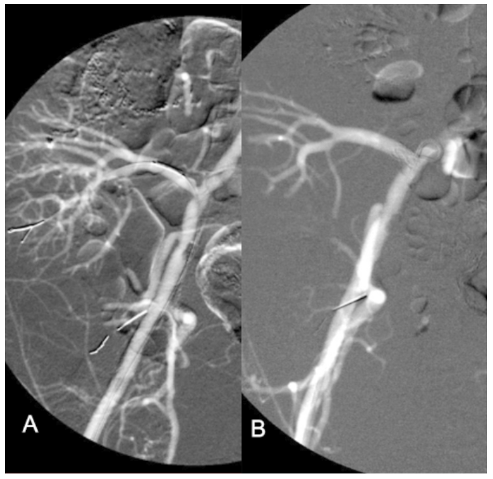 Caridi Digital Subtraction Angiography Figure 20