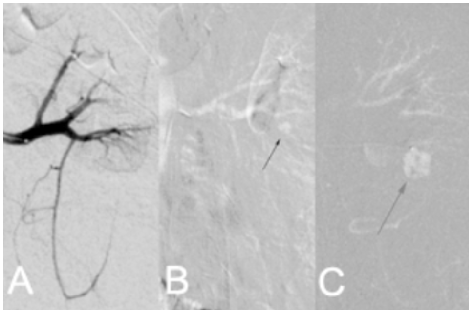 Caridi Digital Subtraction Angiography Figure 21