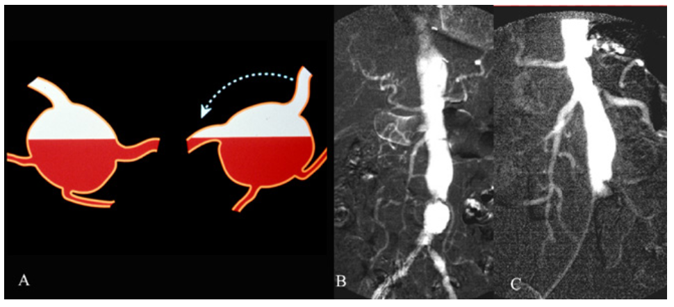 Caridi Digital Subtraction Angiography Figure 22