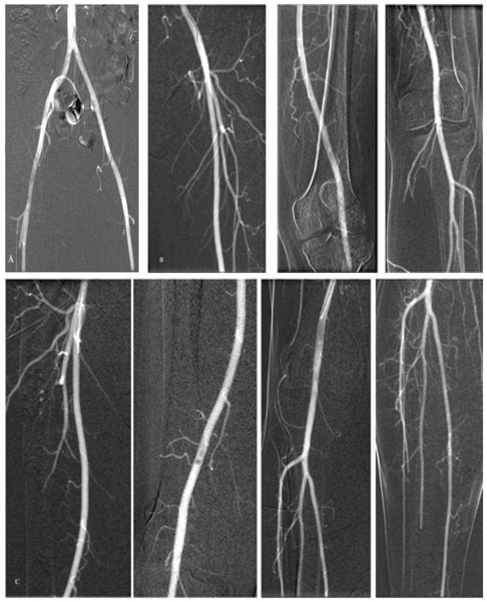Caridi Digital Subtraction Angiography Figure 23