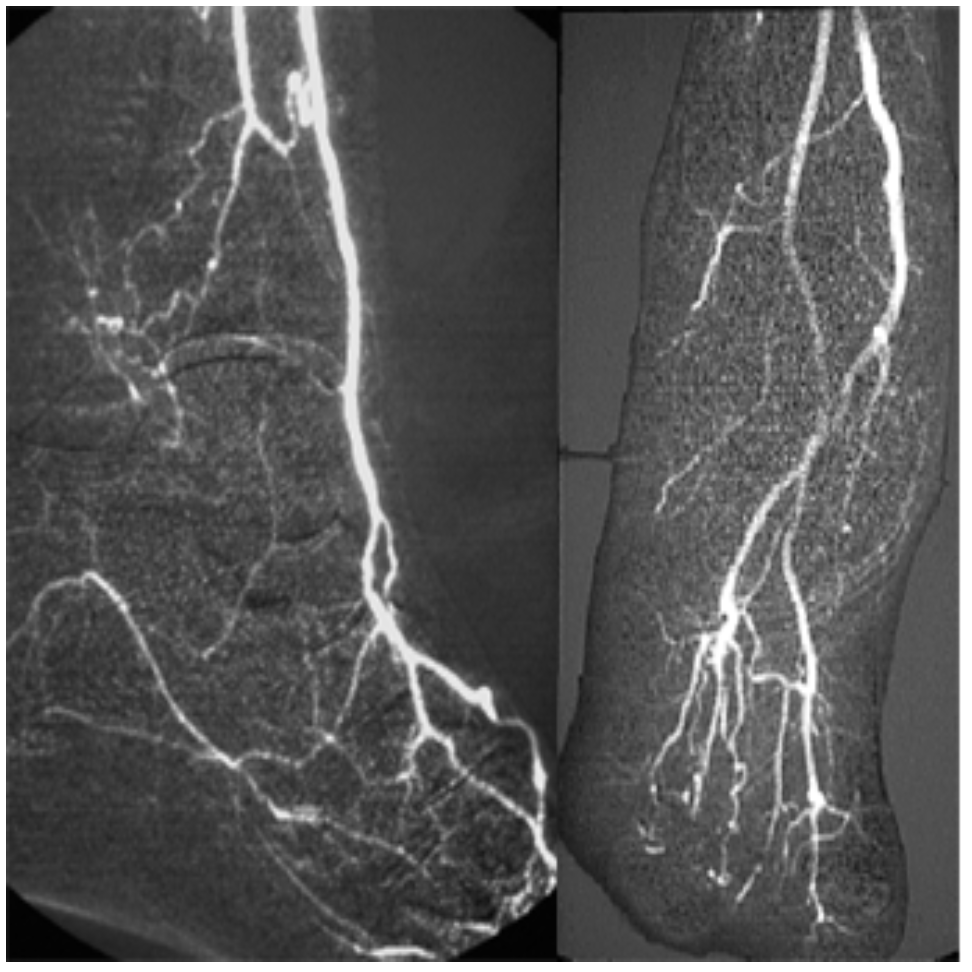 Caridi Digital Subtraction Angiography Figure 24
