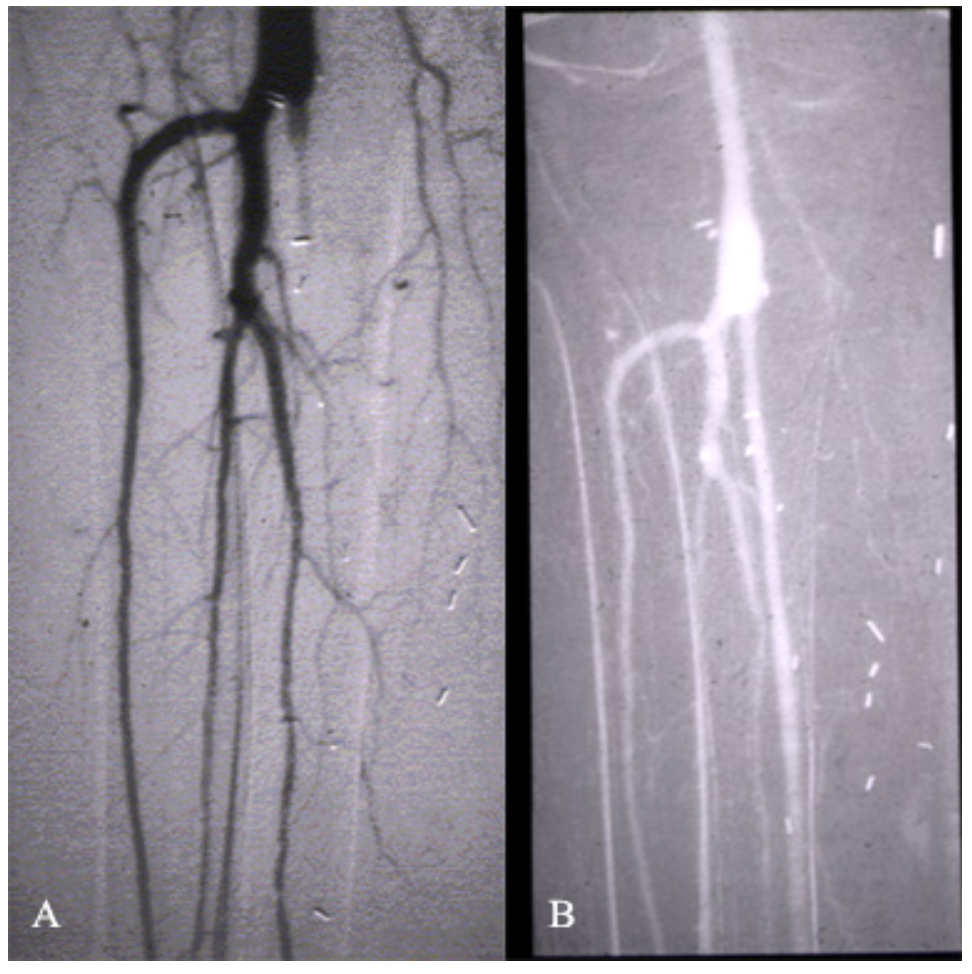 Caridi Digital Subtraction Angiography Figure 25