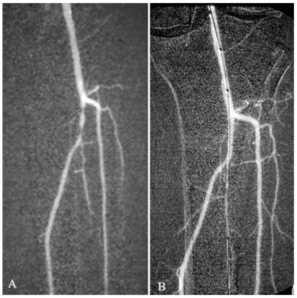 Caridi Digital Subtraction Angiography Figure 26