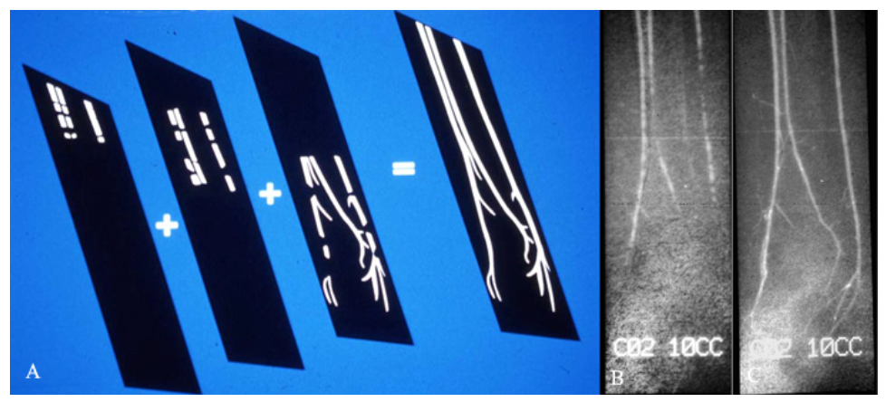 Caridi Digital Subtraction Angiography Figure 27