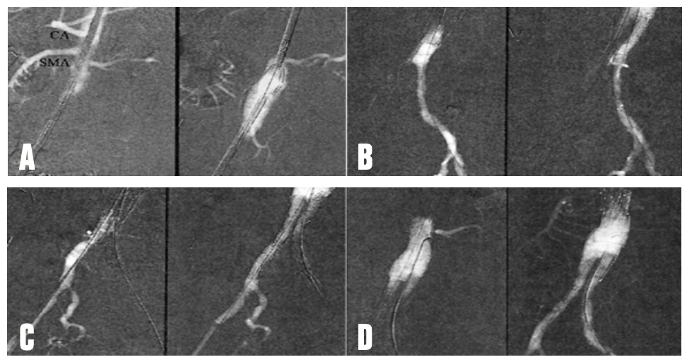 Caridi Digital Subtraction Angiography Figure 28