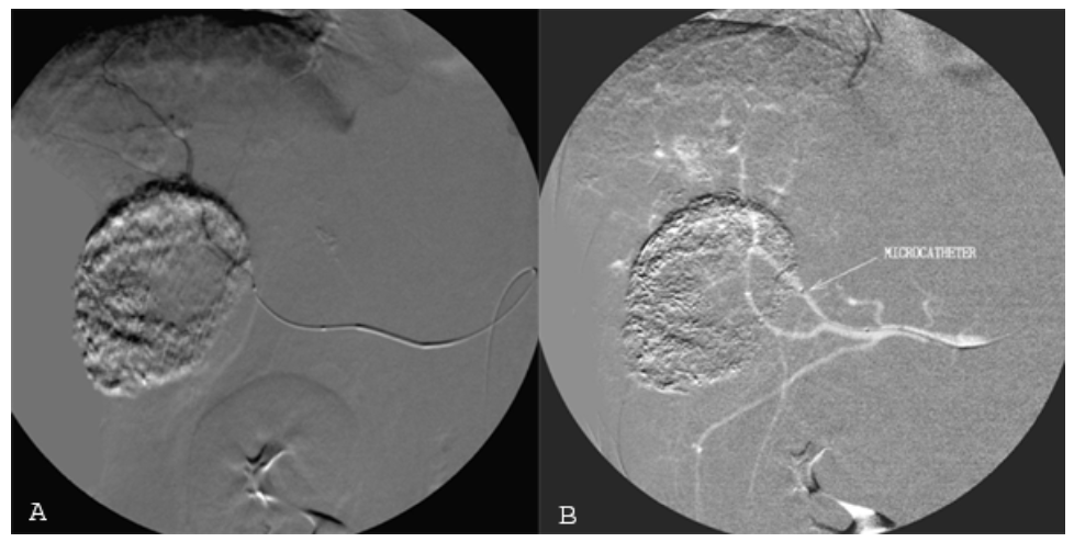 Caridi Digital Subtraction Angiography Figure 29