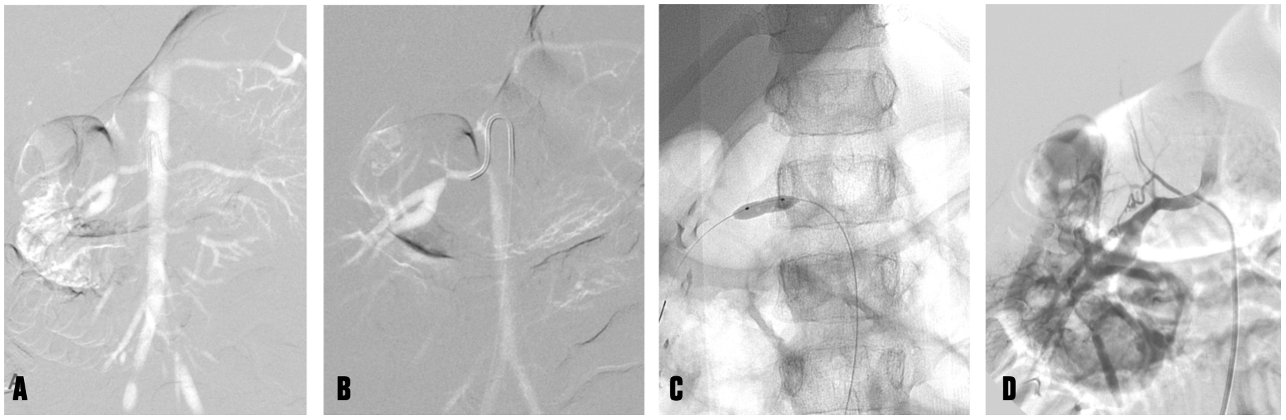 Caridi Digital Subtraction Angiography Figure 3