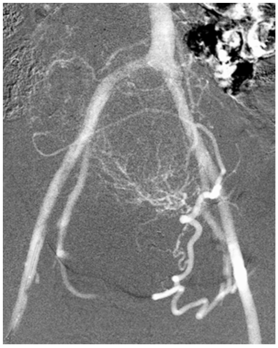 Caridi Digital Subtraction Angiography Figure 30