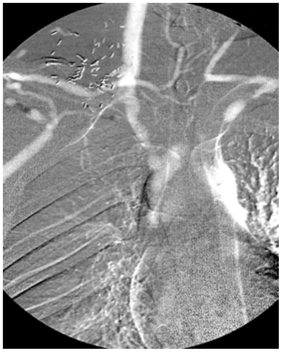 Caridi Digital Subtraction Angiography Figure 31