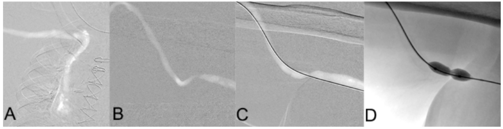 Caridi Digital Subtraction Angiography Figure 32