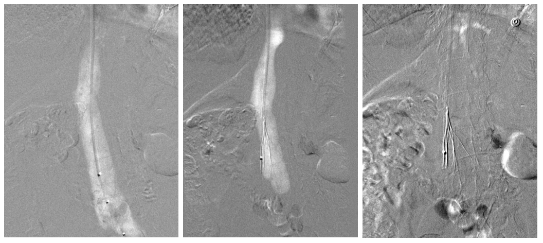 Caridi Digital Subtraction Angiography Figure 33
