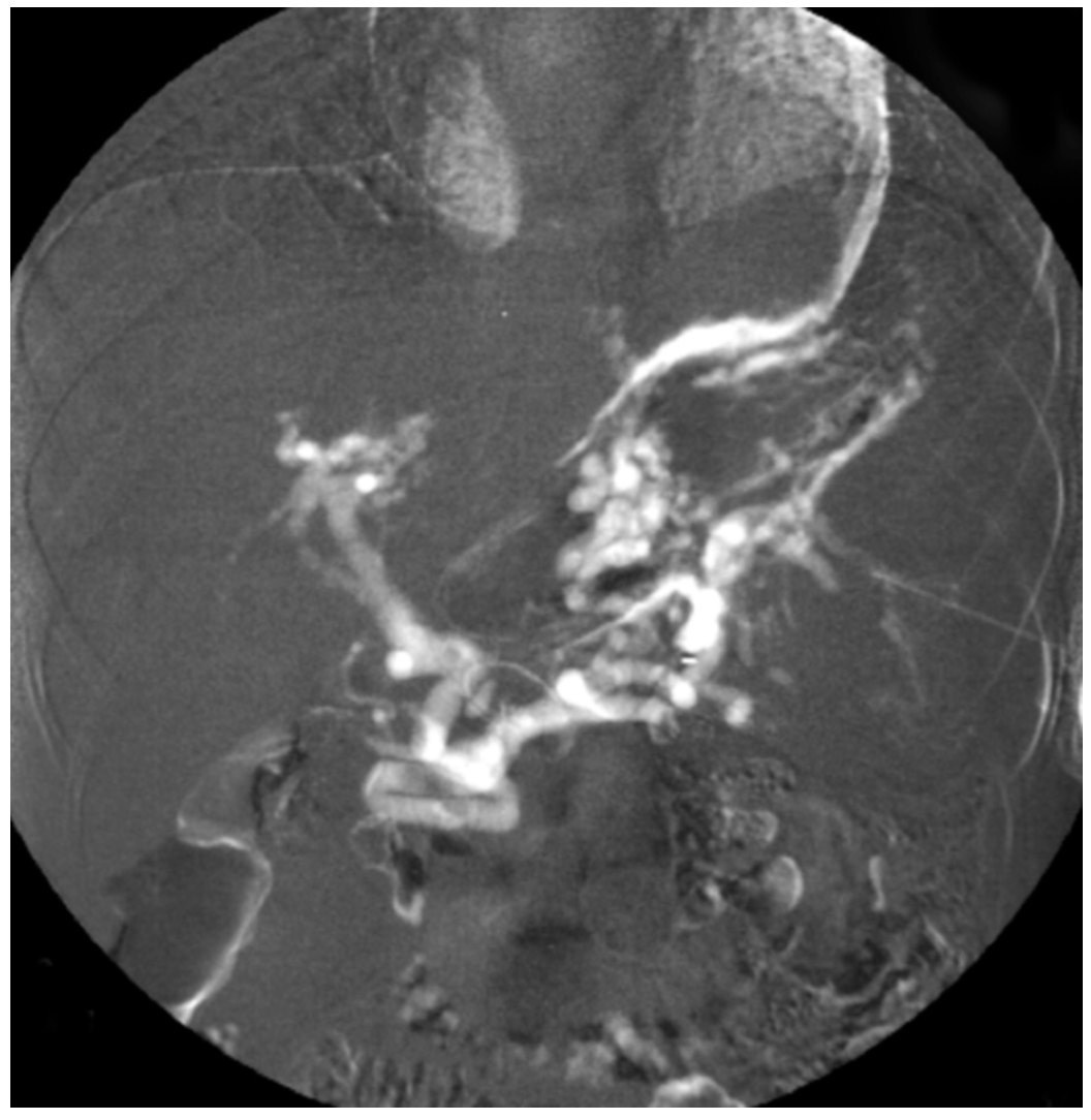 Caridi Digital Subtraction Angiography Figure 34