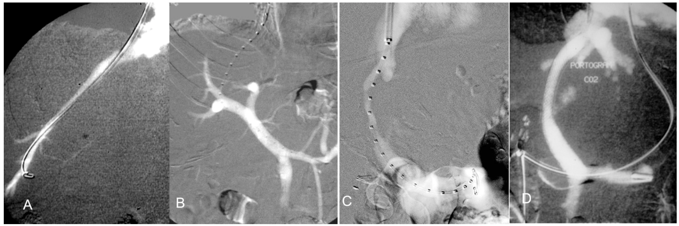 Caridi Digital Subtraction Angiography Figure 35
