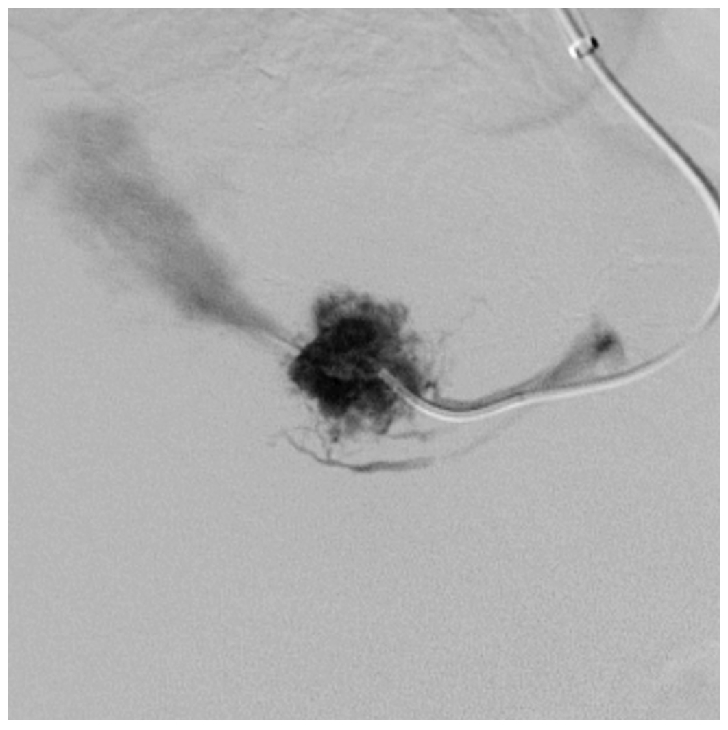 Caridi Digital Subtraction Angiography Figure 36