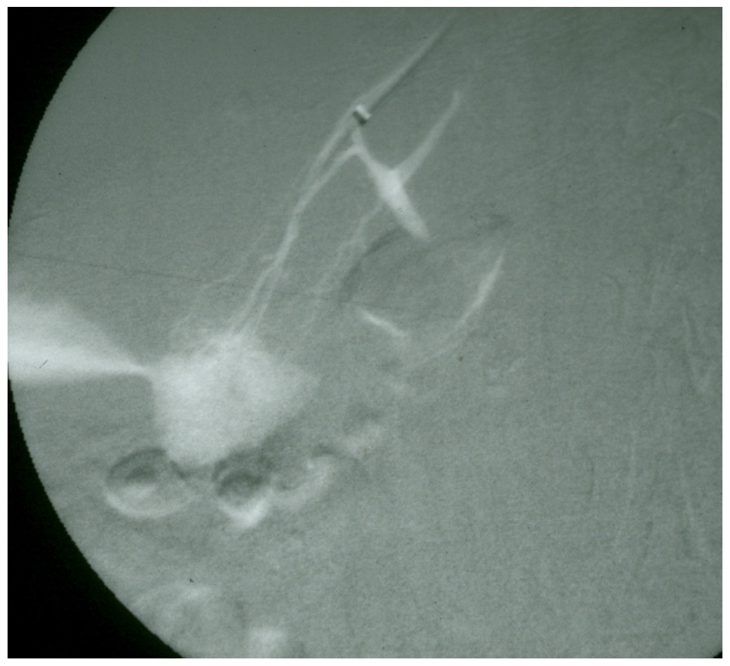 Caridi Digital Subtraction Angiography Figure 37