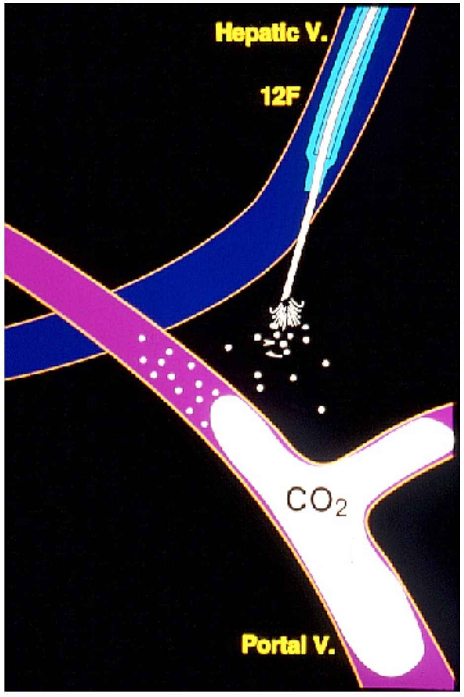 Caridi Digital Subtraction Angiography Figure 38