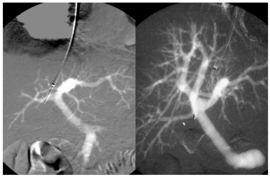 Caridi Digital Subtraction Angiography Figure 39