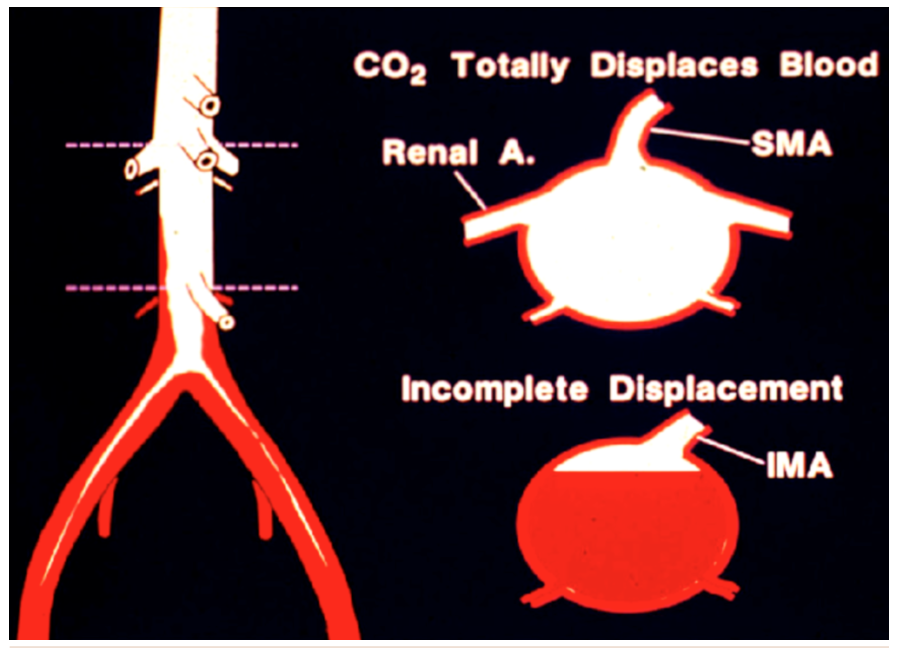 Caridi Digital Subtraction Angiography Figure 4