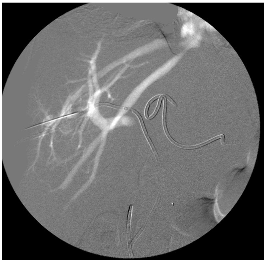 Caridi Digital Subtraction Angiography Figure 40
