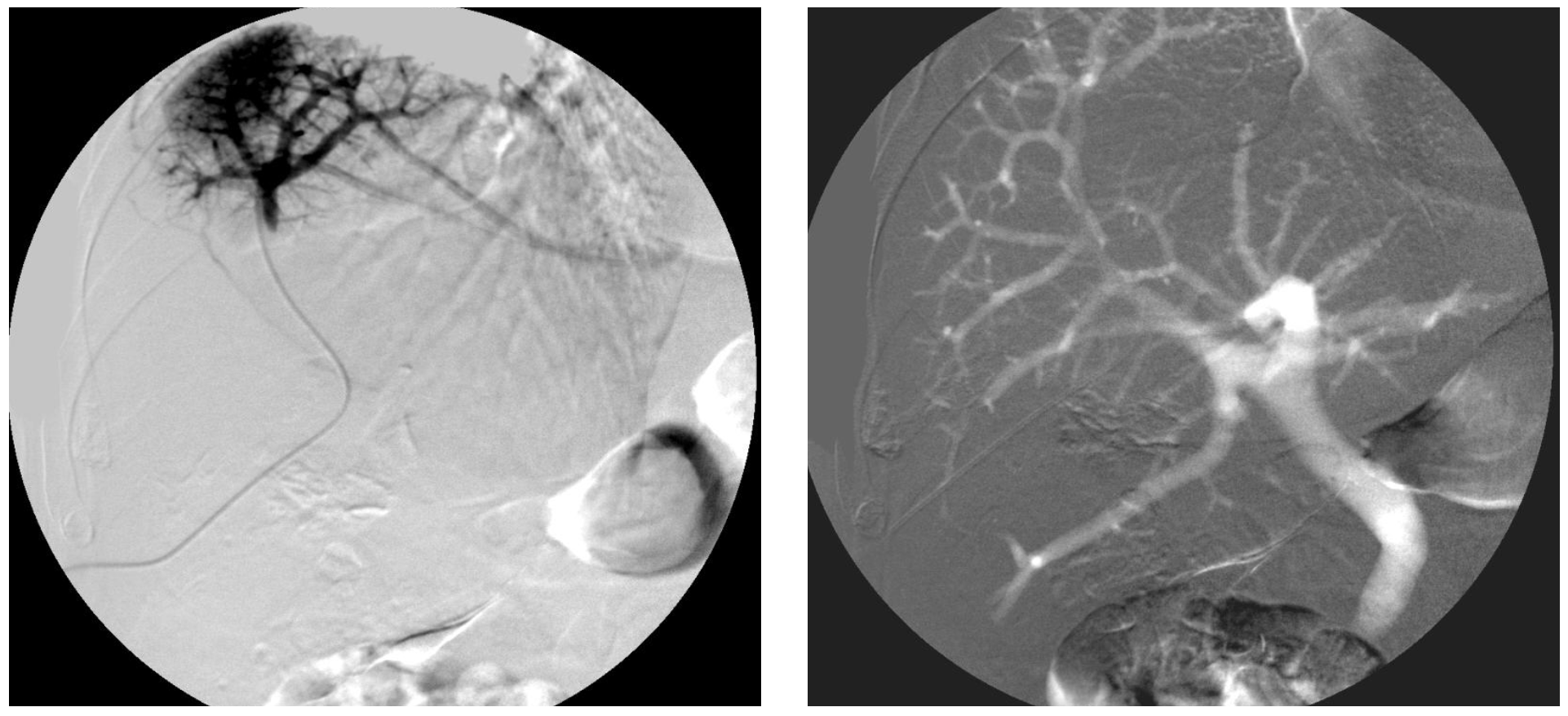 Caridi Digital Subtraction Angiography Figure 41