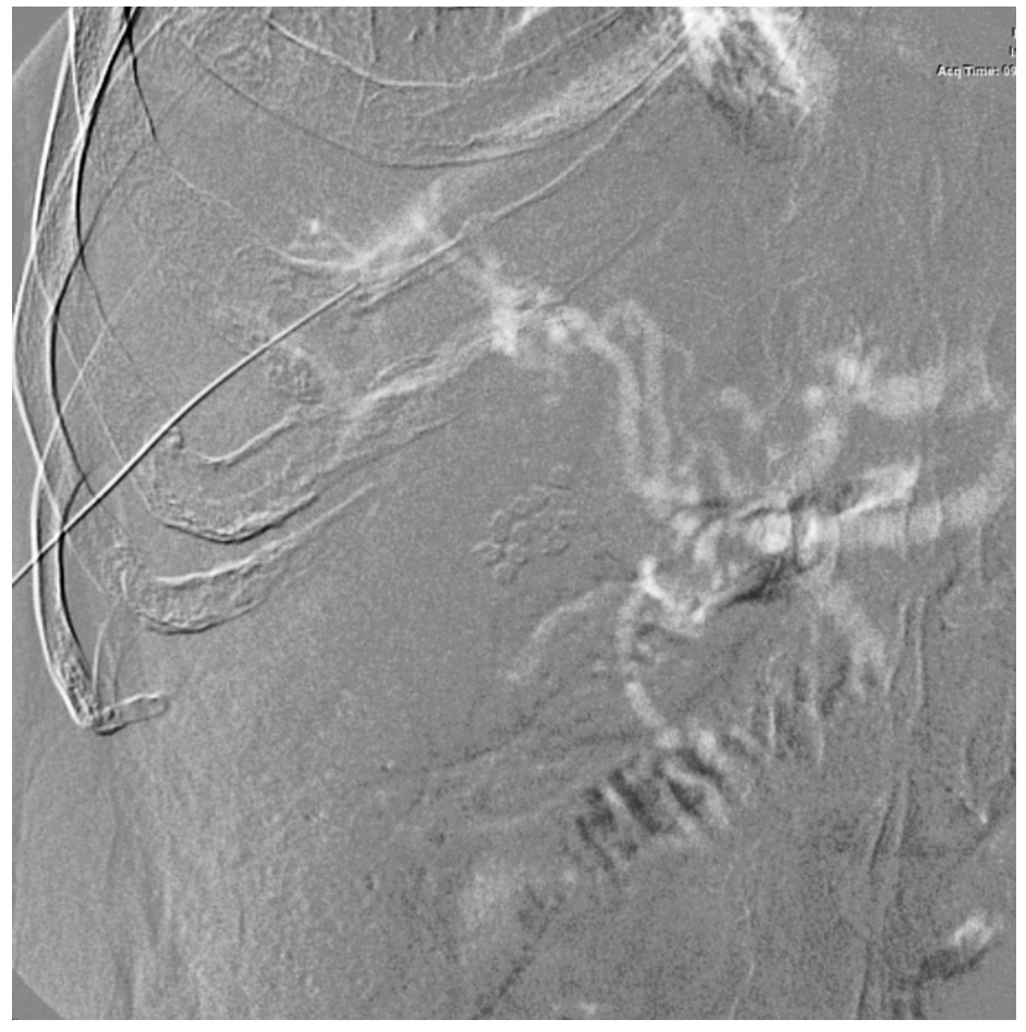 Caridi Digital Subtraction Angiography Figure 42