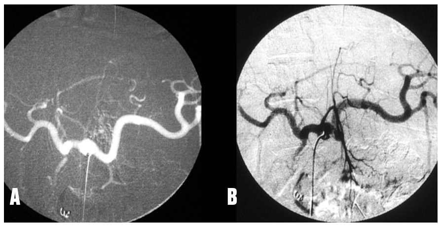 Caridi Digital Subtraction Angiography Figure 5