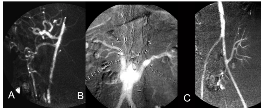 Caridi Digital Subtraction Angiography Figure 6