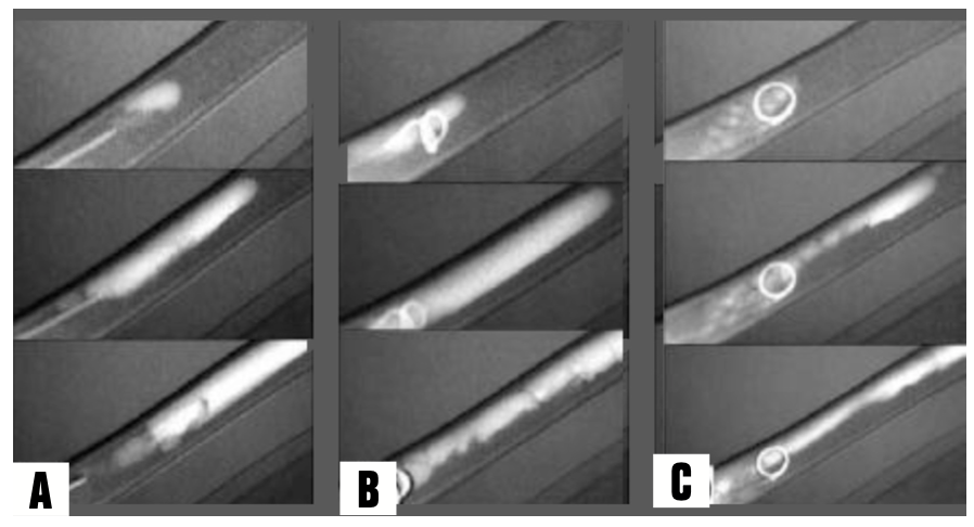 Caridi Digital Subtraction Angiography Figure 7