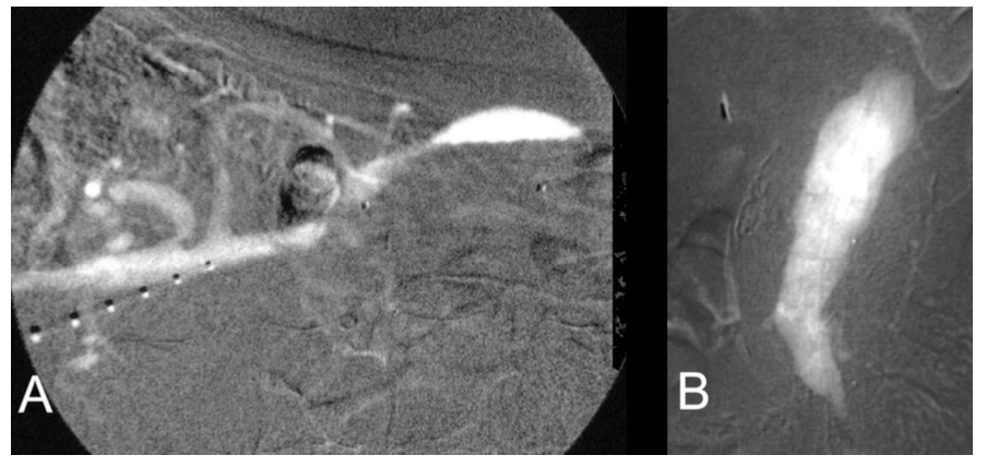 Caridi Digital Subtraction Angiography Figure 8