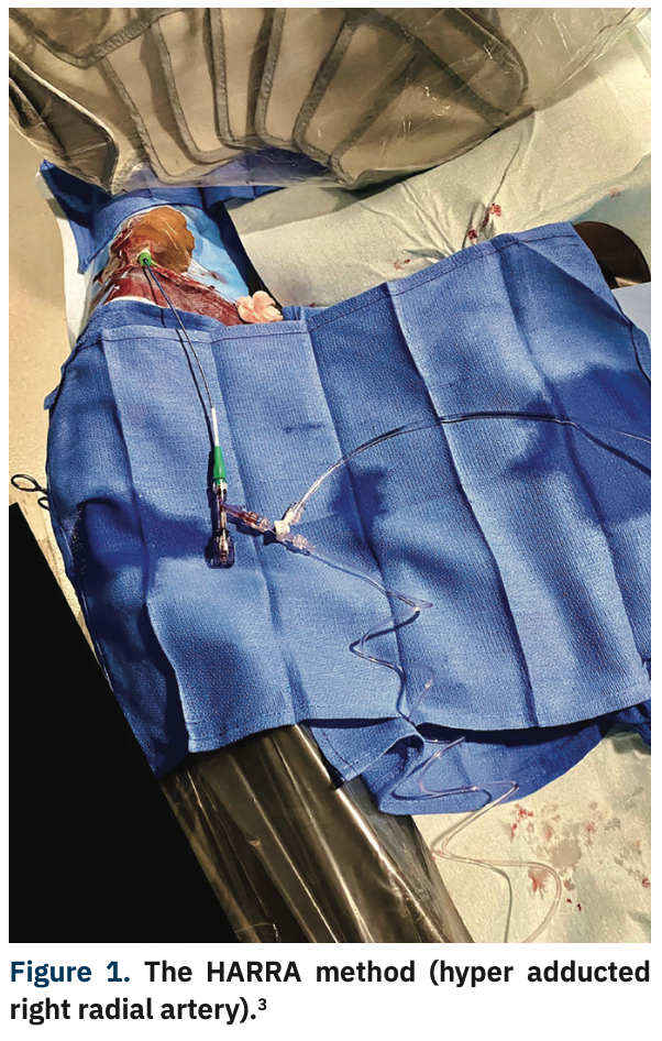 Casazza Coronary Artery Fistula Figure 1