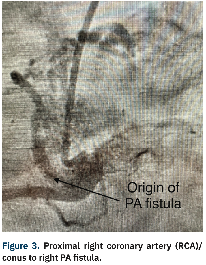 Casazza Coronary Artery Fistula Figure 3