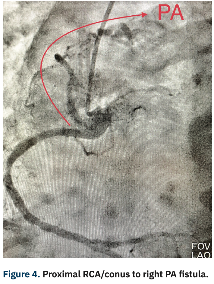 Casazza Coronary Artery Fistula Figure 4