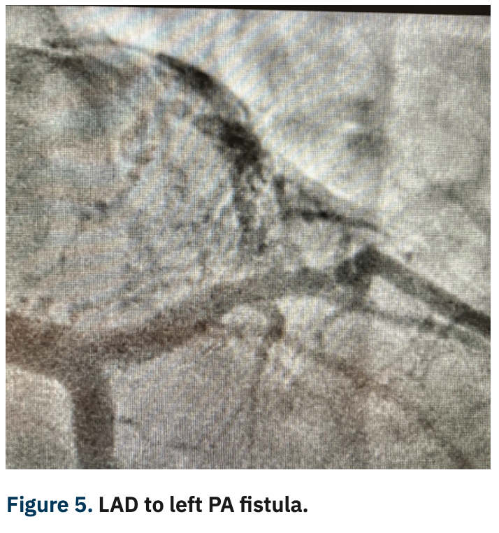 Casazza Coronary Artery Fistula Figure 5
